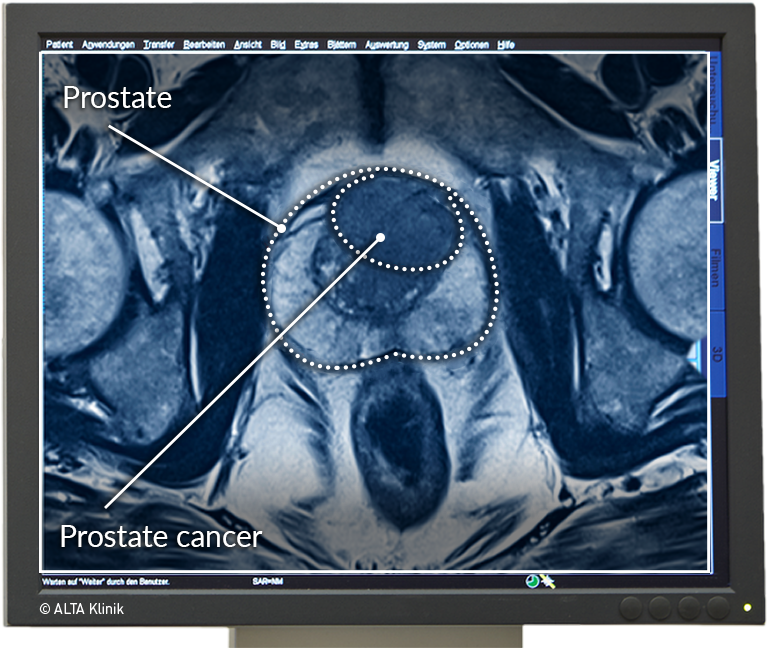 10 Prostate Mri Scan Tips For Accurate Results Your Land